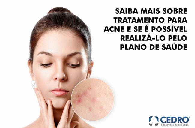 Saiba mais sobre tratamento para acne e se é possível realizá-lo pelo plano de saúde